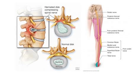 Radiculopathy Treatment - inline physio.