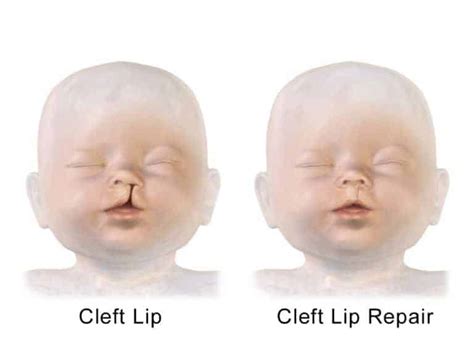 Cleft Lip and Palate - causes, symptoms, treatment, prognosis - Costamedic