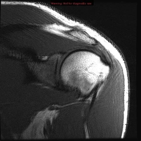 Shoulder MRI Coronal 9 Diagram | Quizlet