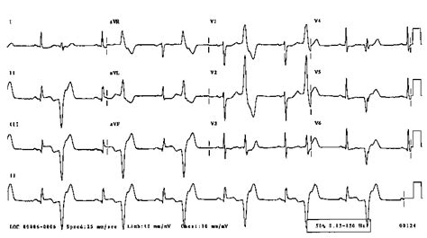 ECG library, Ventricular bigeminy