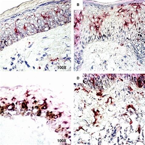 CD1 expression in leprosy skin lesions. A, a few positive cells in ...