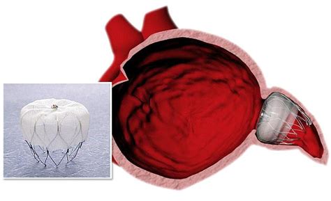 Watchman Heart Device Reduces Risk of Strokes in Atrial Fibrillation Patients