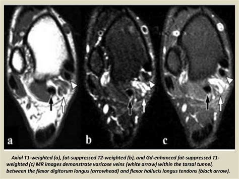 Presentation1 radiological imaging of tarsal tunnel syndrome.