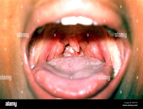 Enlarged tonsils Stock Photo: 4055165 - Alamy