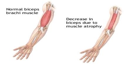 Muscle Atrophy Treatment - Assignment Point