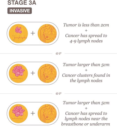 Stage 3 Breast Cancer Overview - National Breast Cancer Foundation