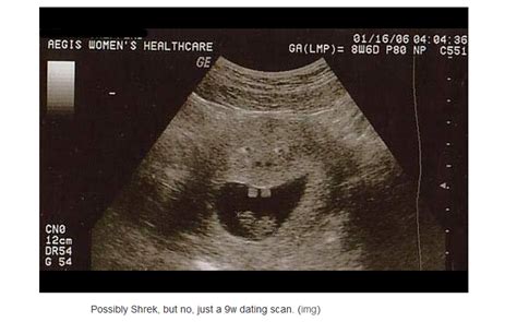 Check Out These Hilariously Funny Ultrasound Pictures of Unborn Babies - LifeNews.com | Unborn ...