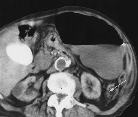 CT of Cecal Volvulus Unraveling the Image | AJR