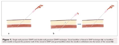 Traditional Seldinger Technique | Vascular Disease Management