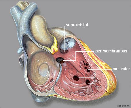 Ventricular septal defect (VSD) | Learn the Heart