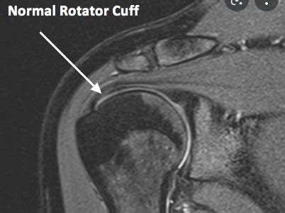 Shoulder Bursitis – Dr. Edward Weldon