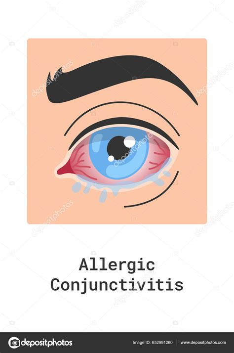 Allergic Conjunctivitis Eye Disease Vector Illustration Stock Vector by ...