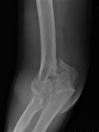 Distal Humerus Anatomy