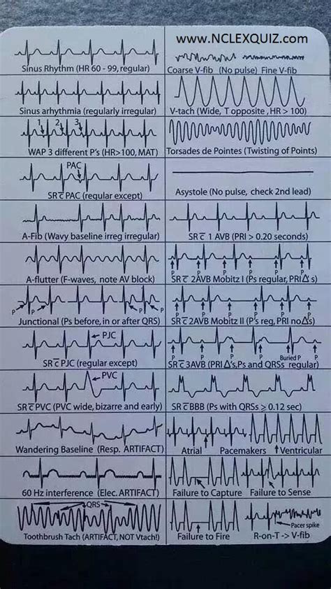 EKG Heart Rhythms Cheat Sheet - NCLEX Quiz