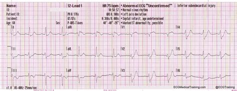 De Winter ST/T-Waves - ECG Medical Training