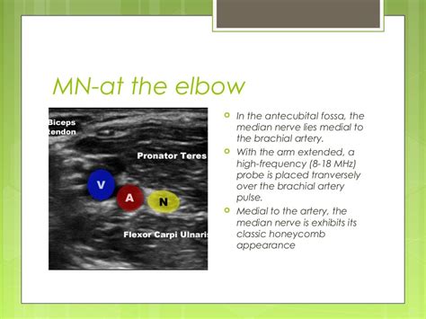 Ultrasound Guided Peripheral Nerve Blocks