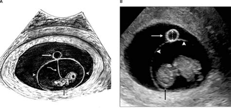 Sonographic Evaluation of the Yolk Sac - Tan - 2012 - Journal of Ultrasound in Medicine - Wiley ...