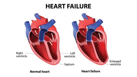 Systolic Heart Failure: Symptoms, Causes, Diagnosis, Treatment & Prevention | Treat, Cure Fast