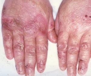 Epidermolysis Bullosa - Pictures, Treatment, Life Expectancy