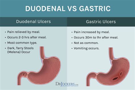 Duodenal Ulcer