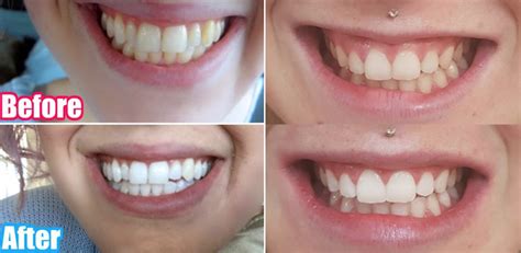 Snow Teeth Whitening Reviews And User Guideline - ITGust