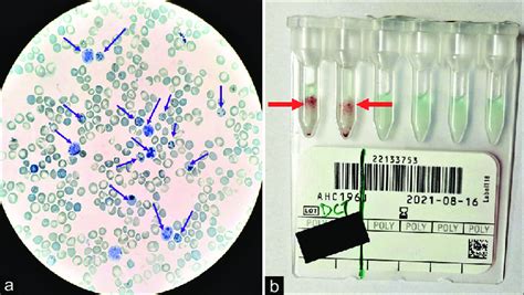 (Case 3) (a) Supravital staining on PBS showing marked reticulocytosis... | Download Scientific ...