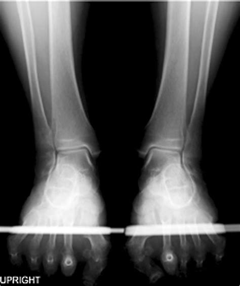 A-66-year-old female with pes planovalgus: our hindfoot x-ray image ...