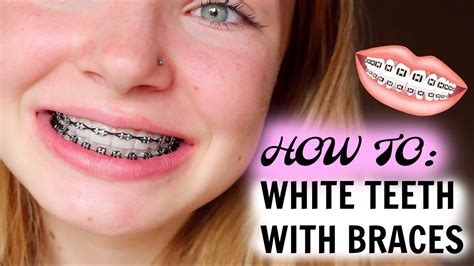 How To Get Pearly White Teeth With Braces - TeethWalls