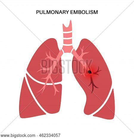 Pulmonary Embolism Vector & Photo (Free Trial) | Bigstock