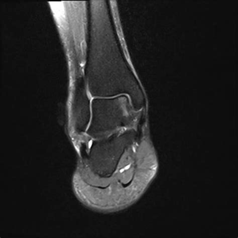 Talar dome lesion (OCD) - DocMartins Foot & Ankle Clinics