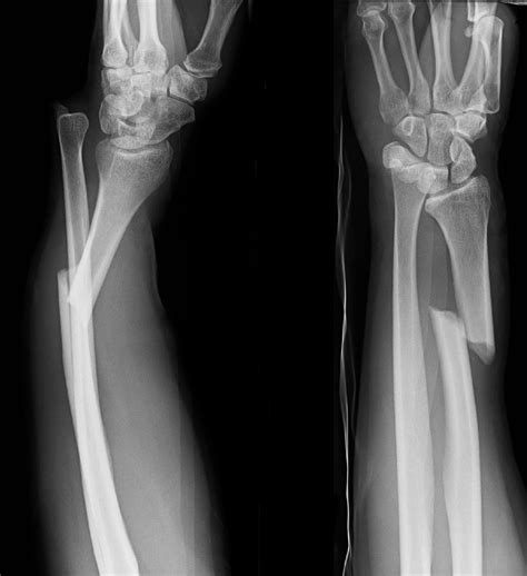 Galeazzi fracture-dislocations