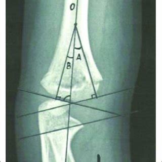 Radiography of the elbow supracondylar fracture. Baumann's angle is 73°... | Download Scientific ...