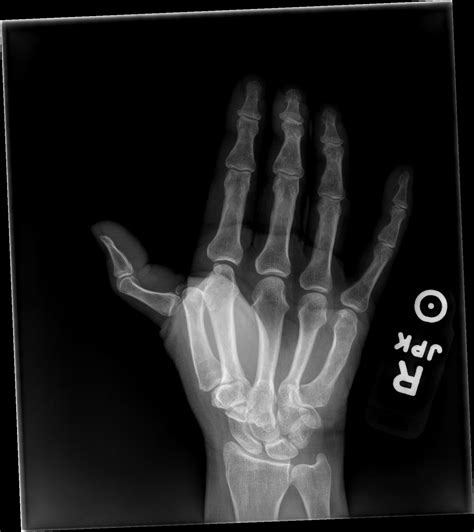 THUMB DISLOCATION | buyxraysonline