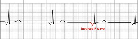 Junctional Bradycardia Rhythm Strip