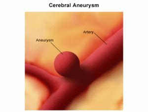 aneurysm treatment - Neurosurgeons of New Jersey