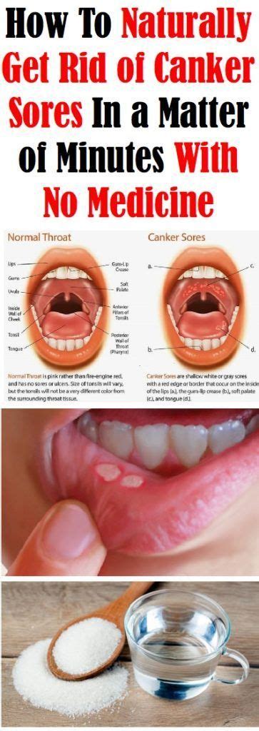 HOW TO NATURALLY GET RID OF CANKER SORES IN MINUTES WITH NO MEDICINE ...