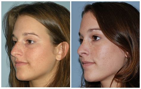 Atlanta Septoplasty & Rhinoplasty Before and After Photos