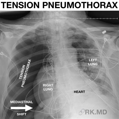 Icd 10 Code For Tension Pneumothorax - Miriam Segura