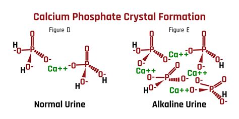 Calcium Phosphate Kidney Stones- The Source & Remedy | Stone Relief