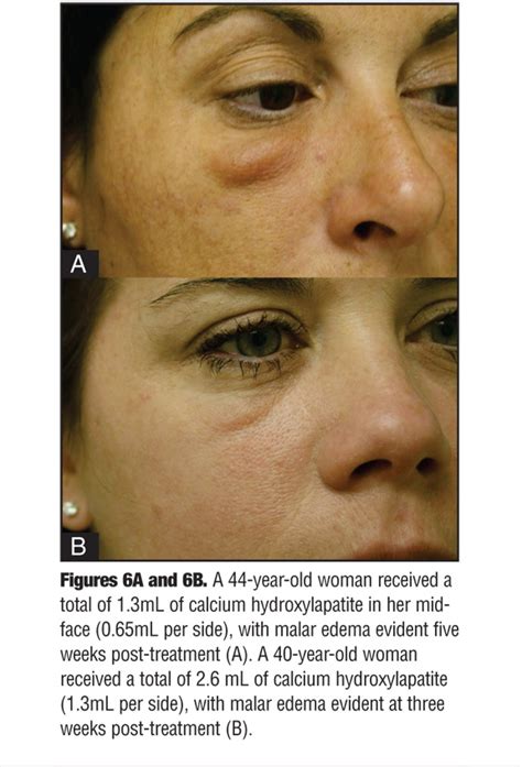 Avoiding Malar Edema During Midface/Cheek Augmentation with Dermal ...