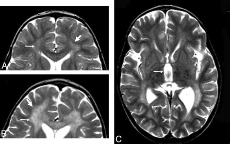 Metachromatic leukodystrophy