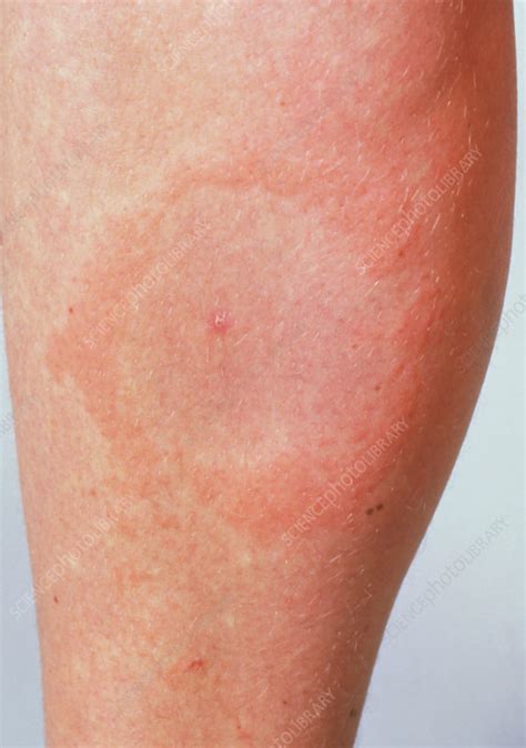 Lyme disease rash - Stock Image - M200/0089 - Science Photo Library