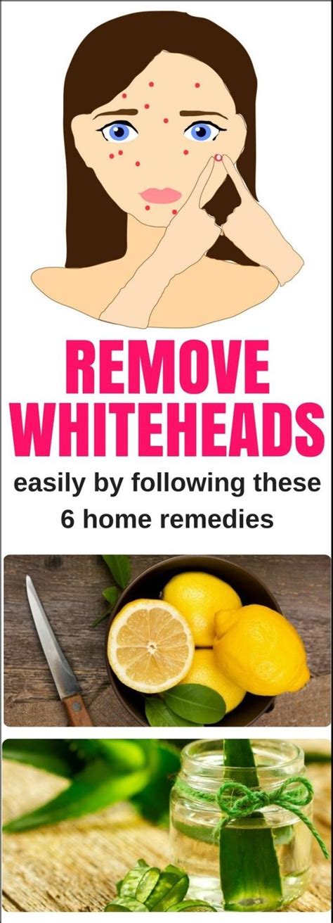 Remove Whiteheads Easily By Following These 6 Home Remedies!!! - EXPLORE HEALTH