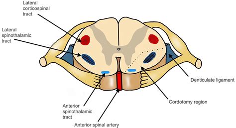 Open thoracic anterolateral cordotomy for pain relief in children ...