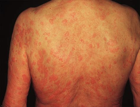 Pruritic Urticarial Skin Lesions —Quiz Case | Allergy and Clinical Immunology | JAMA Dermatology ...