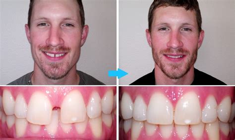 Specialist Teeth Gap Filling at Smile Craft