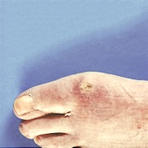 What is Scleroderma Symptoms & Treatment in Australia Sydney