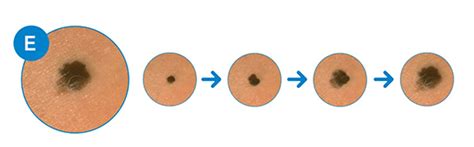 Skin Cancer Moles On Legs