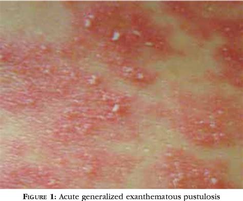 Figure 1 from Neutrophilic dermatoses-Part I Dermatoses neutrofílicas – Parte I | Semantic Scholar