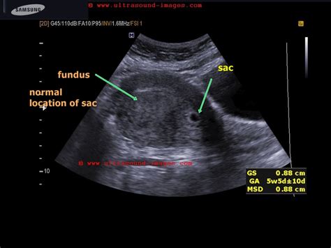 Implantation Ultrasound